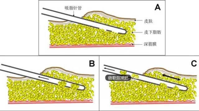 半永久化妝是微整形嗎？兩者有什么區(qū)別？